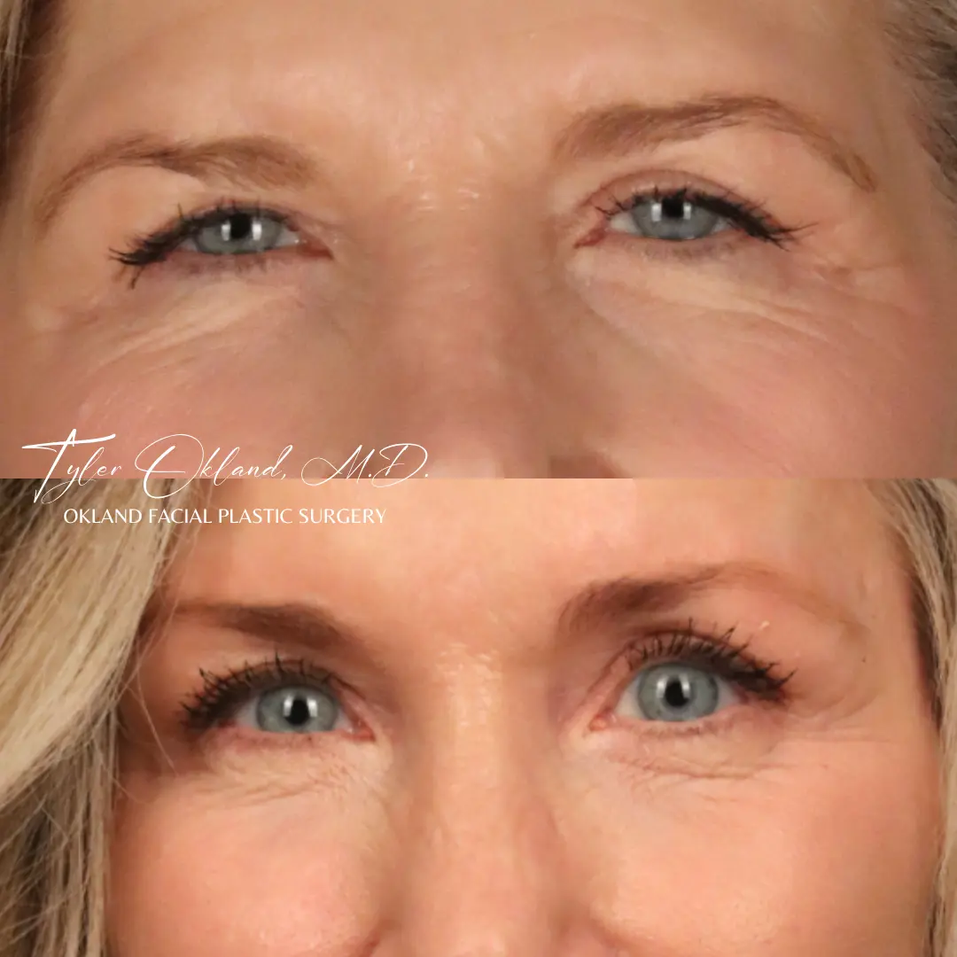 Brow lift before and after by Tyler Okland, MD in Denver, frontal view
