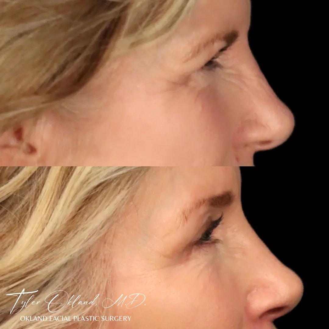 Brow lift before and after by Tyler Okland, MD in Denver, profile view