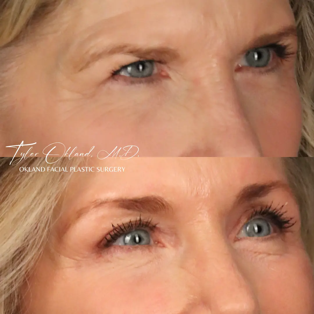 Brow lift before and after by Tyler Okland, MD in Denver, three-quarter view