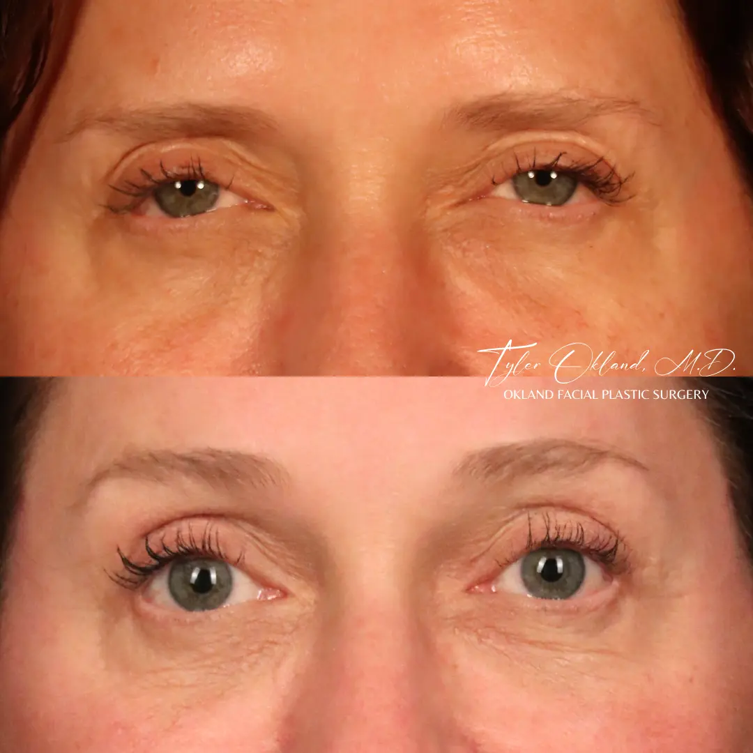 Eye-area detail after endoscopic brow lift in a 58-year-old patient