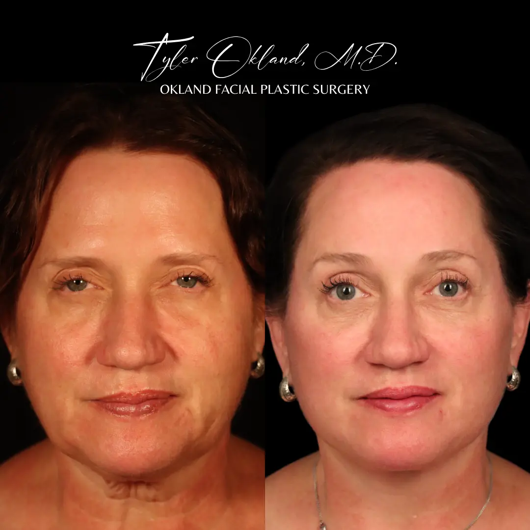 58-year-old patient four months after combined facial rejuvenation including endoscopic brow lift, frontal view