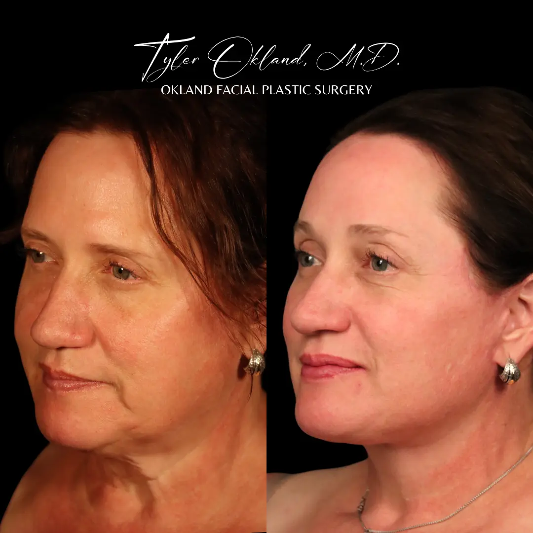 58-year-old patient four months after combined facial rejuvenation including endoscopic brow lift, three-quarter view