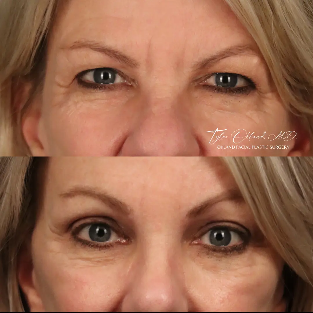 Additional patient before and after brow lift