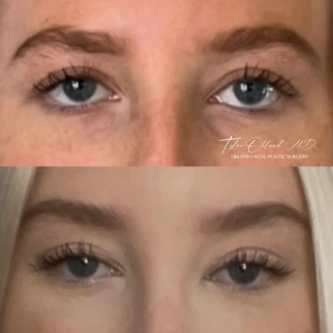 26-year-old patient before and three months after endoscopic brow lift by Tyler Okland, MD