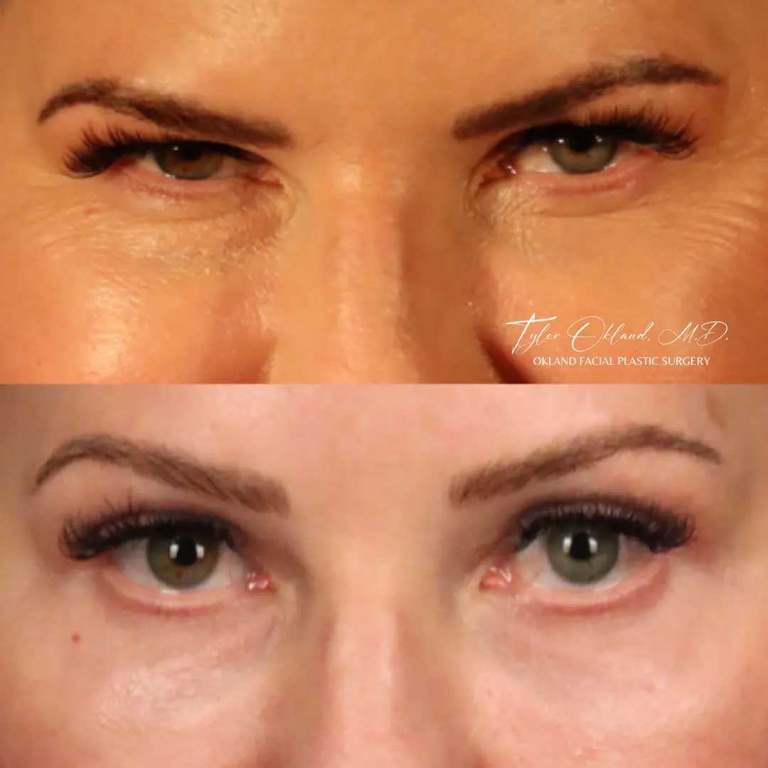 26-year-old patient before and three months after endoscopic brow lift by Tyler Okland, MD
