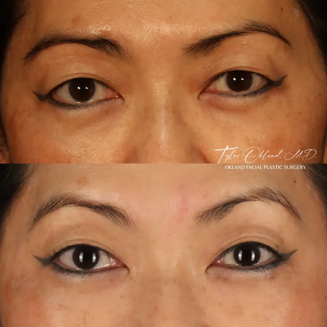 56-year-old female one year after endoscopic brow lift
