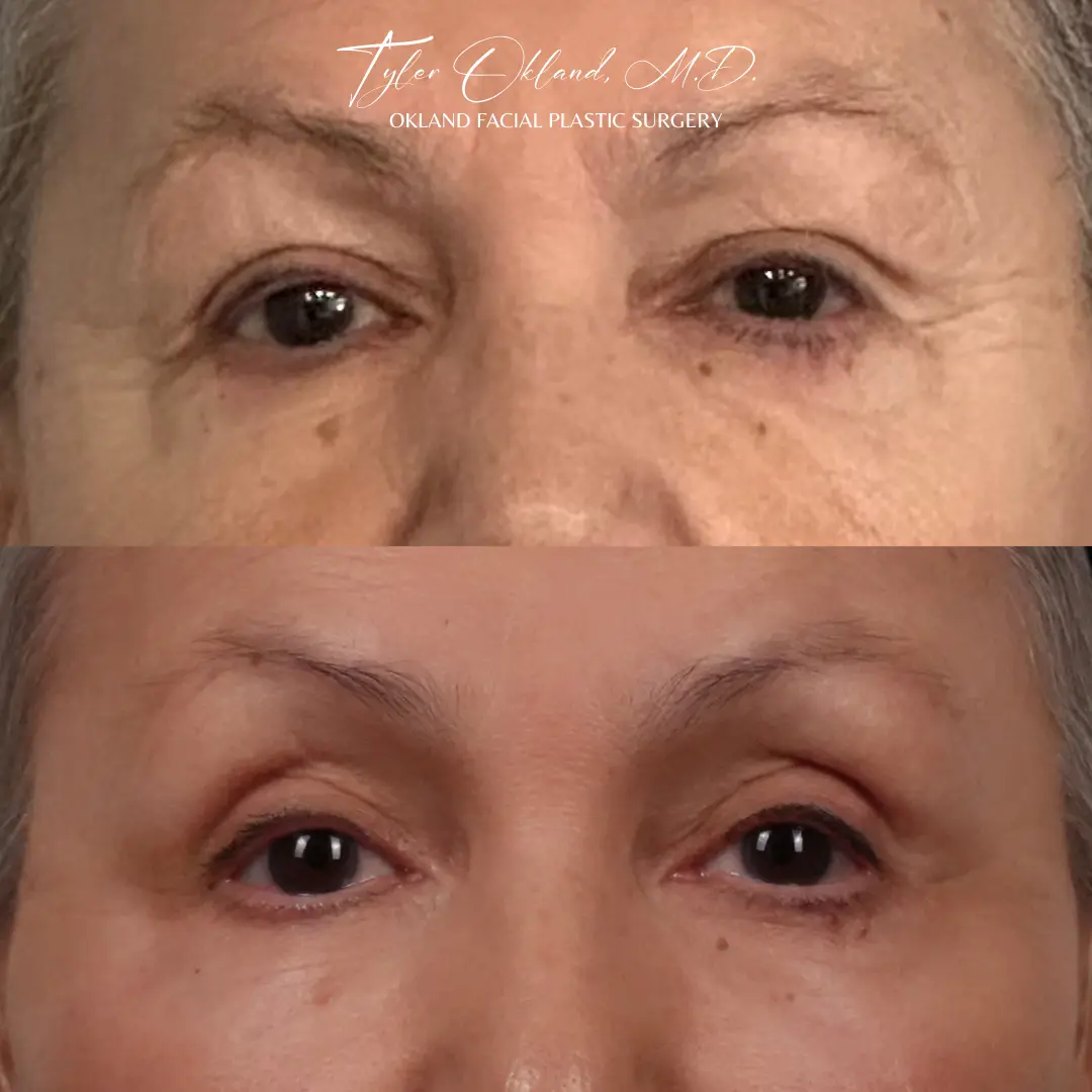 71-year-old female three months after endoscopic brow lift