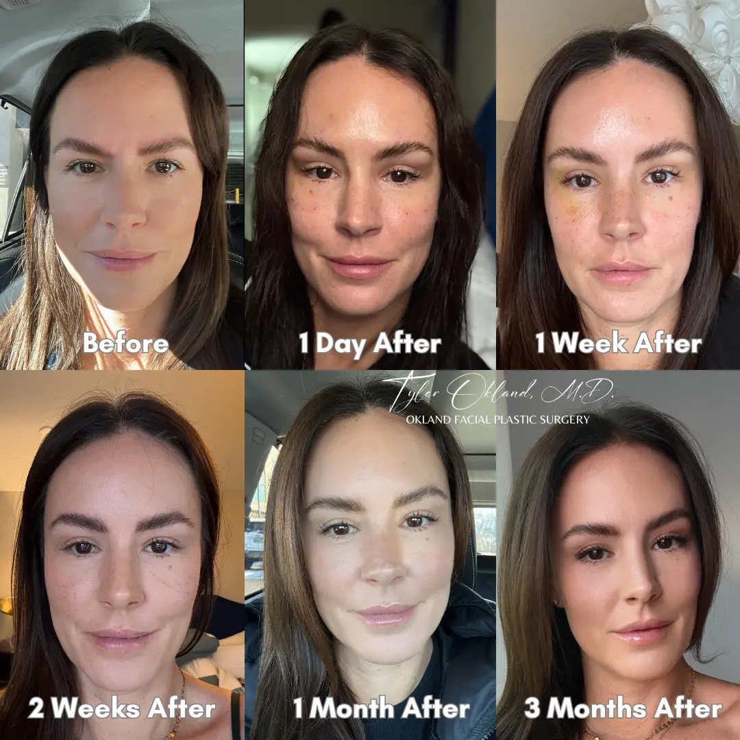 Endoscopic brow lift recovery progression from before surgery through three months