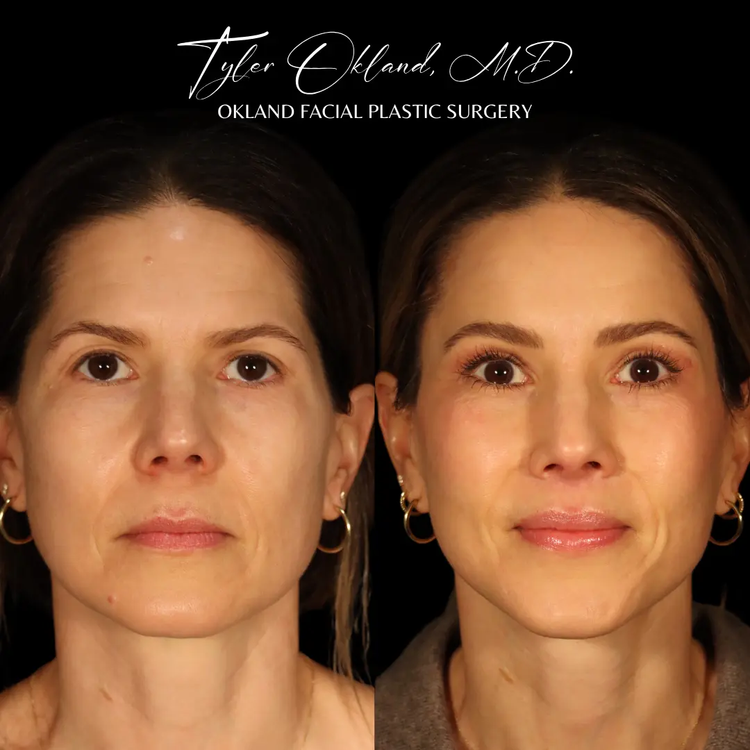 45-year-old patient 18 months after extended deep plane facelift and endoscopic brow lift, frontal view