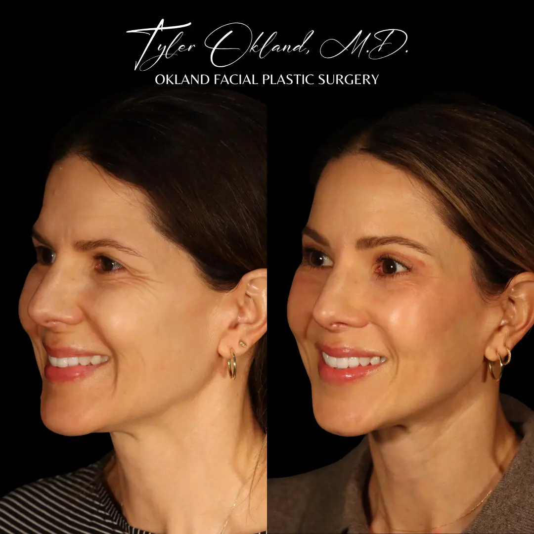 45-year-old patient after combined facial rejuvenation, profile view