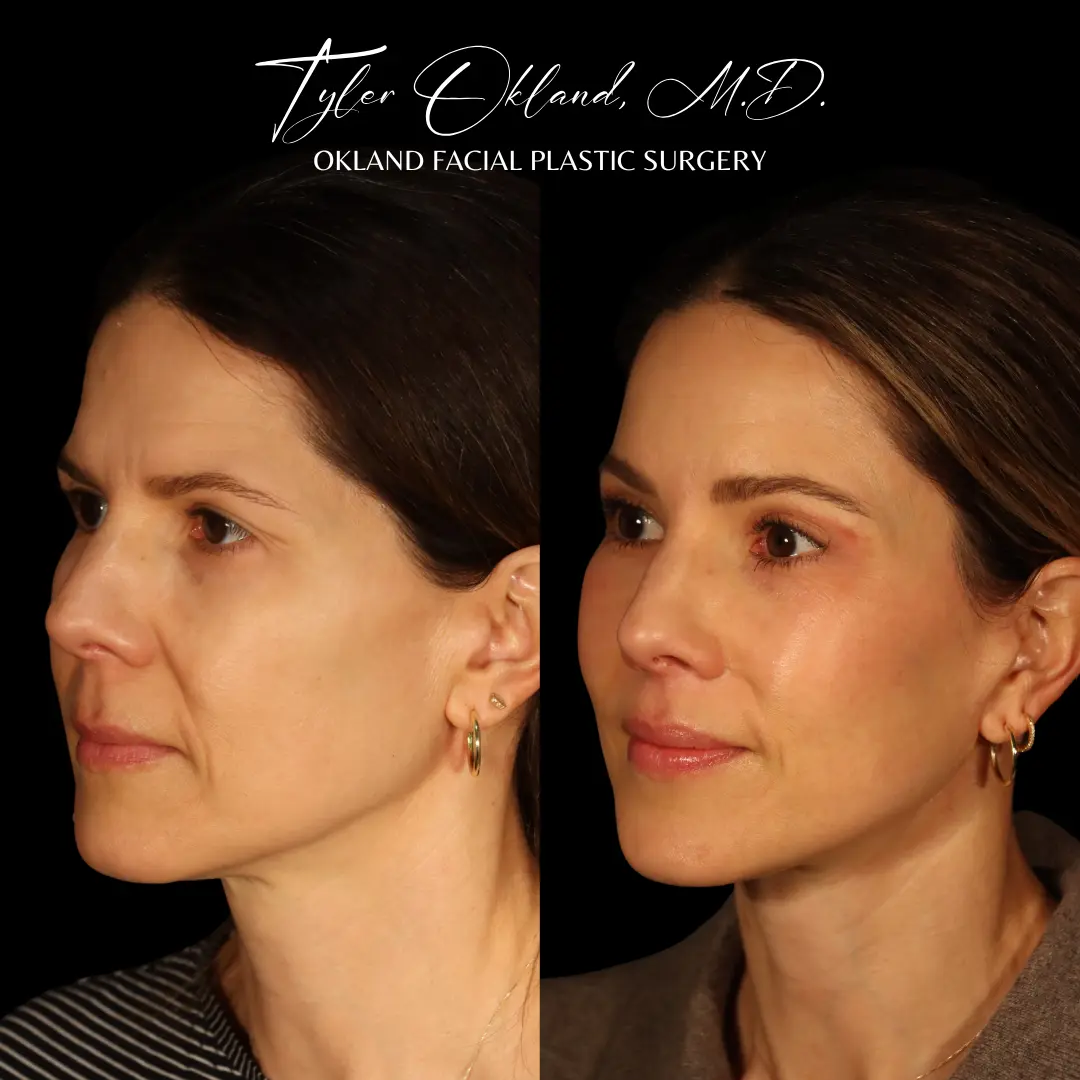 45-year-old patient after combined facial rejuvenation, three-quarter view